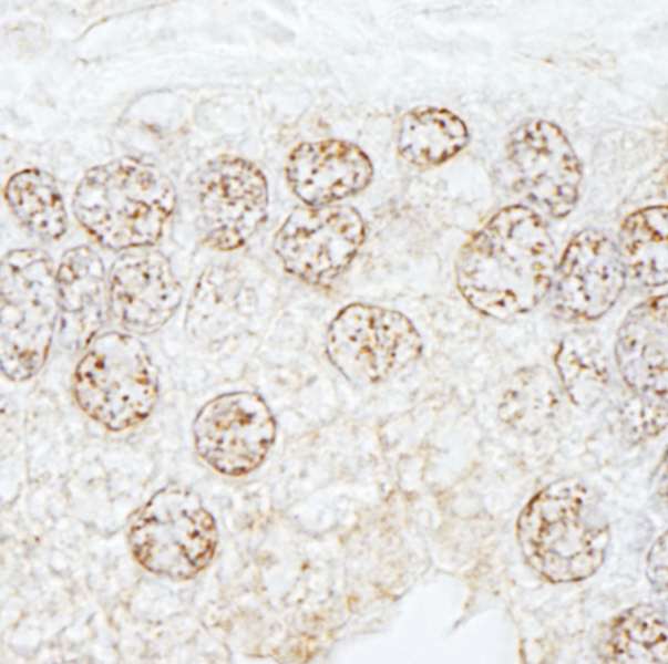 Detection of Human METTL3/MT-A70 by Immunohistochemistry. Sample: FFPE section of human prostate carcinoma. Antibody: Affinity purified rabbit anti-METTL3/MT-A70 used at a dilution of 1:1000 (0.2 ug/ml). Detection: DAB.