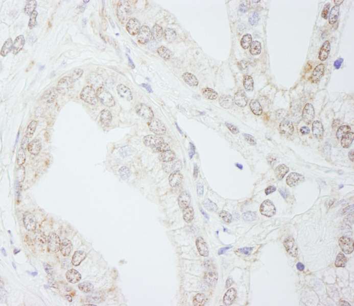 Detection of Human METTL3/MT-A70 by Immunohistochemistry. Sample: FFPE section of human prostate carcinoma. Antibody: Affinity purified rabbit anti-METTL3/MT-A70 used at a dilution of 1:1000 (1 ug/ml). Detection: DAB.
