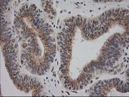 IHC of paraffin-embedded Adenocarcinoma of Human endometrium tissue using anti-MGLL mouse monoclonal antibody. (Heat-induced epitope retrieval by 10mM citric buffer, pH6.0, 100C for 10min).