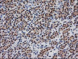 IHC of paraffin-embedded Carcinoma of Human thyroid tissue using anti-MGLL mouse monoclonal antibody. (Heat-induced epitope retrieval by 10mM citric buffer, pH6.0, 100C for 10min).