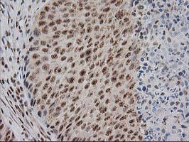 IHC of paraffin-embedded Carcinoma of Human bladder tissue using anti-MGLL mouse monoclonal antibody. (Heat-induced epitope retrieval by 10mM citric buffer, pH6.0, 100C for 10min).