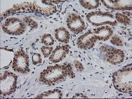 IHC of paraffin-embedded Carcinoma of Human prostate tissue using anti-MGLL mouse monoclonal antibody. (Heat-induced epitope retrieval by 10mM citric buffer, pH6.0, 100C for 10min).