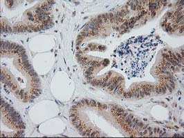 IHC of paraffin-embedded Adenocarcinoma of Human colon tissue using anti-MGLL mouse monoclonal antibody. (Heat-induced epitope retrieval by 10mM citric buffer, pH6.0, 100C for 10min).