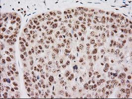 IHC of paraffin-embedded Adenocarcinoma of Human breast tissue using anti-MGLL mouse monoclonal antibody. (Heat-induced epitope retrieval by 10mM citric buffer, pH6.0, 100C for 10min).