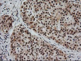 IHC of paraffin-embedded Carcinoma of Human pancreas tissue using anti-MGLL mouse monoclonal antibody. (Heat-induced epitope retrieval by 10mM citric buffer, pH6.0, 100C for 10min).