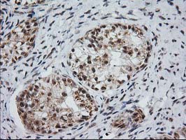 IHC of paraffin-embedded Adenocarcinoma of Human ovary tissue using anti-MGLL mouse monoclonal antibody. (Heat-induced epitope retrieval by 10mM citric buffer, pH6.0, 100C for 10min).