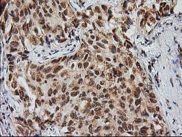 IHC of paraffin-embedded Carcinoma of Human lung tissue using anti-MGLL mouse monoclonal antibody. (Heat-induced epitope retrieval by 10mM citric buffer, pH6.0, 100C for 10min).