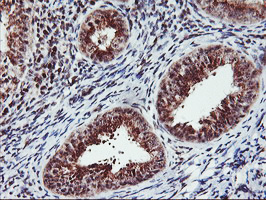 IHC of paraffin-embedded Adenocarcinoma of Human endometrium tissue using anti-MGLL mouse monoclonal antibody.
