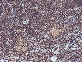 IHC of paraffin-embedded Human lymphoma tissue using anti-MGLL mouse monoclonal antibody.