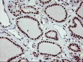 IHC of paraffin-embedded Carcinoma of Human thyroid tissue using anti-MGLL mouse monoclonal antibody.