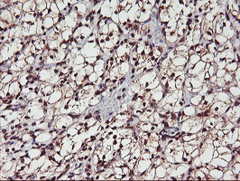IHC of paraffin-embedded Carcinoma of Human kidney tissue using anti-MGLL mouse monoclonal antibody.