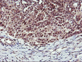 IHC of paraffin-embedded Adenocarcinoma of Human ovary tissue using anti-MGLL mouse monoclonal antibody.