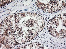 IHC of paraffin-embedded Adenocarcinoma of Human ovary tissue using anti-MGLL mouse monoclonal antibody.