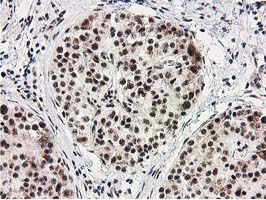 IHC of paraffin-embedded Carcinoma of Human pancreas tissue using anti-MGLL mouse monoclonal antibody. (Heat-induced epitope retrieval by 10mM citric buffer, pH6.0, 100C for 10min).