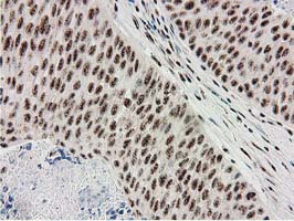 IHC of paraffin-embedded Carcinoma of Human bladder tissue using anti-MGLL mouse monoclonal antibody. (Heat-induced epitope retrieval by 10mM citric buffer, pH6.0, 100C for 10min).