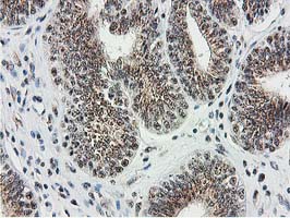 IHC of paraffin-embedded Adenocarcinoma of Human endometrium tissue using anti-MGLL mouse monoclonal antibody. (Heat-induced epitope retrieval by 10mM citric buffer, pH6.0, 100C for 10min).