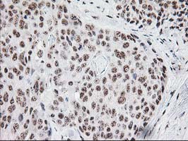 IHC of paraffin-embedded Adenocarcinoma of Human breast tissue using anti-MGLL mouse monoclonal antibody. (Heat-induced epitope retrieval by 10mM citric buffer, pH6.0, 100C for 10min).
