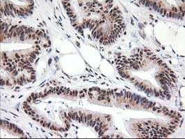 IHC of paraffin-embedded Adenocarcinoma of Human colon tissue using anti-MGLL mouse monoclonal antibody. (Heat-induced epitope retrieval by 10mM citric buffer, pH6.0, 100C for 10min).