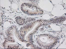 IHC of paraffin-embedded Adenocarcinoma of Human colon tissue using anti-MGLL mouse monoclonal antibody.