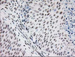 IHC of paraffin-embedded Carcinoma of Human bladder tissue using anti-MGLL mouse monoclonal antibody.