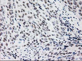 IHC of paraffin-embedded Adenocarcinoma of Human breast tissue using anti-MGLL mouse monoclonal antibody.