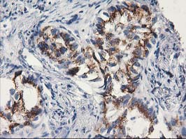 IHC of paraffin-embedded Carcinoma of Human lung tissue using anti-MGLL mouse monoclonal antibody.