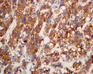 IHC of paraffin-embedded human liver carcinoma tissue using anti-MSP antibody.