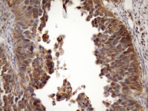 IHC of paraffin-embedded Carcinoma of Human kidney tissue using anti-MST1 mouse monoclonal antibody. (Heat-induced epitope retrieval by Tris-EDTA, pH8.0)(1:150).