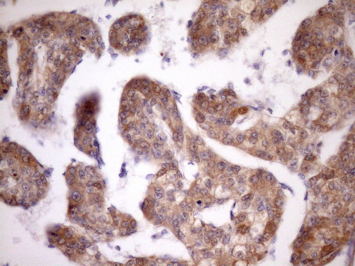 IHC of paraffin-embedded Carcinoma of Human liver tissue using anti-MST1 mouse monoclonal antibody. (Heat-induced epitope retrieval by Tris-EDTA, pH8.0)(1:150).