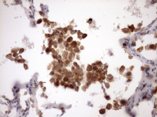 IHC of paraffin-embedded Carcinoma of Human lung tissue using anti-MST1 mouse monoclonal antibody. (Heat-induced epitope retrieval by Tris-EDTA, pH8.0)(1:150).