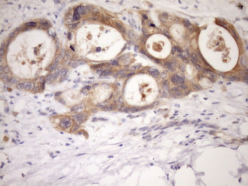 IHC of paraffin-embedded Adenocarcinoma of Human colon tissue using anti-MST1 mouse monoclonal antibody. (Heat-induced epitope retrieval by Tris-EDTA, pH8.0)(1:150).