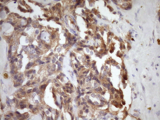 IHC of paraffin-embedded Adenocarcinoma of Human breast tissue using anti-MST1 mouse monoclonal antibody. (Heat-induced epitope retrieval by Tris-EDTA, pH8.0)(1:150).