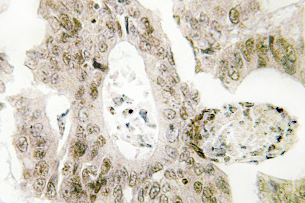 IHC of MYH (Y176) pAb in paraffin-embedded human colon carcinoma tissue.