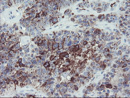 IHC of paraffin-embedded Carcinoma of Human pancreas tissue using anti-MYL7 mouse monoclonal antibody.