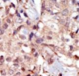 Formalin-fixed and paraffin-embedded human cancer tissue reacted with the primary antibody, which was peroxidase-conjugated to the secondary antibody, followed by DAB staining. This data demonstrates the use of this antibody for immunohistochemistry; clinical relevance has not been evaluated. BC = breast carcinoma; HC = hepatocarcinoma.