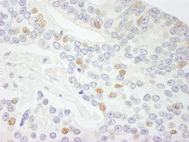 Detection of Human NCOA5 (CIA) by Immunohistochemistry. Sample: FFPE section of human prostate carcinoma. Antibody: Affinity purified rabbit anti-NCOA5 (CIA) used at a dilution of 1:200 (1 ug/ml). Detection: DAB.