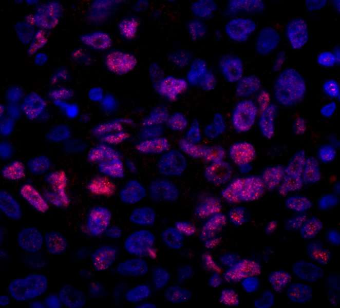 Detection of Human NCOA5/CIA by Immunohistochemistry. Sample: FFPE section of human ovarian carcinoma. Antibody: Affinity purified rabbit anti-NCOA5/CIA used at a dilution of 1:100. Detection: Red-fluorescent goat anti-rabbit IgG highly cross-adsorbed Antibody used at a dilution of 1:100. Epitope Retrieval Buffer-High pH (IHC-101J) was substituted for Epitope Retrieval Buffer-Reduced pH.
