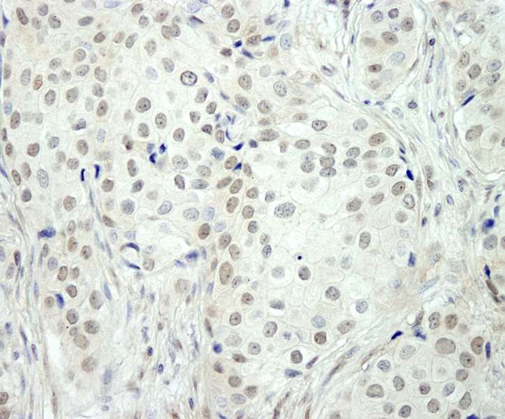 Detection of Human NCOA5/CIA by Immunohistochemistry. Sample: FFPE section of human breast carcinoma. Antibody: Affinity purified rabbit anti-NCOA5/CIA used at a dilution of 1:250. Epitope Retrieval Buffer-High pH (IHC-101J) was substituted for Epitope Retrieval Buffer-Reduced pH.