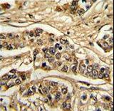 Formalin-fixed and paraffin-embedded human breast carcinoma reacted with NCS1 Antibody , which was peroxidase-conjugated to the secondary antibody, followed by DAB staining. This data demonstrates the use of this antibody for immunohistochemistry; clinical relevance has not been evaluated.