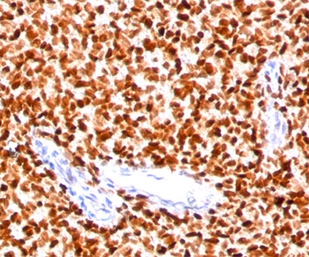 NKX2.2 antibody NX2/294 immunohistochemistry Ewings sarcoma