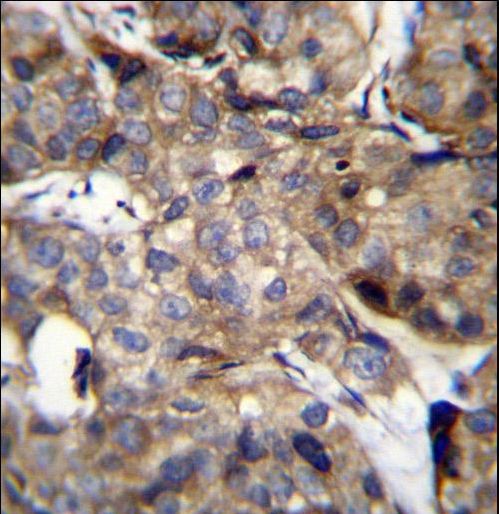 TM4SF1 Antibody immunohistochemistry of formalin-fixed and paraffin-embedded human breast carcinoma followed by peroxidase-conjugated secondary antibody and DAB staining.