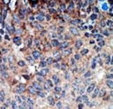 Formalin-fixed and paraffin-embedded human cancer tissue reacted with the primary antibody, which was peroxidase-conjugated to the secondary antibody, followed by DAB staining. This data demonstrates the use of this antibody for immunohistochemistry; clinical relevance has not been evaluated. BC = breast carcinoma; HC = hepatocarcinoma.