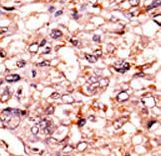 Formalin-fixed and paraffin-embedded human cancer tissue reacted with the primary antibody, which was peroxidase-conjugated to the secondary antibody, followed by AEC staining. This data demonstrates the use of this antibody for immunohistochemistry; clinical relevance has not been evaluated. BC = breast carcinoma; HC = hepatocarcinoma.