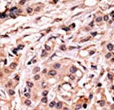 Formalin-fixed and paraffin-embedded human cancer tissue reacted with the primary antibody, which was peroxidase-conjugated to the secondary antibody, followed by AEC staining. This data demonstrates the use of this antibody for immunohistochemistry; clinical relevance has not been evaluated. BC = breast carcinoma; HC = hepatocarcinoma.
