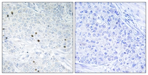 IHC of paraffin-embedded human breast carcinoma tissue, using TP53INP2 Antibody. The picture on the right is treated with the synthesized peptide.