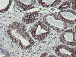 IHC of paraffin-embedded Carcinoma of Human prostate tissue using anti-TPD52L3 mouse monoclonal antibody.