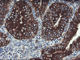 IHC of paraffin-embedded Adenocarcinoma of Human endometrium tissue using anti-TPD52L3 mouse monoclonal antibody.