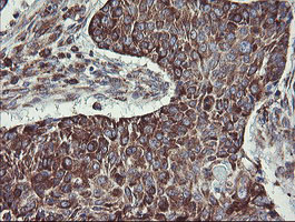 IHC of paraffin-embedded Carcinoma of Human lung tissue using anti-TPD52L3 mouse monoclonal antibody.