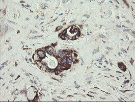IHC of paraffin-embedded Adenocarcinoma of Human colon tissue using anti-TPD52L3 mouse monoclonal antibody.