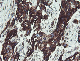 IHC of paraffin-embedded Adenocarcinoma of Human breast tissue using anti-TPD52L3 mouse monoclonal antibody.